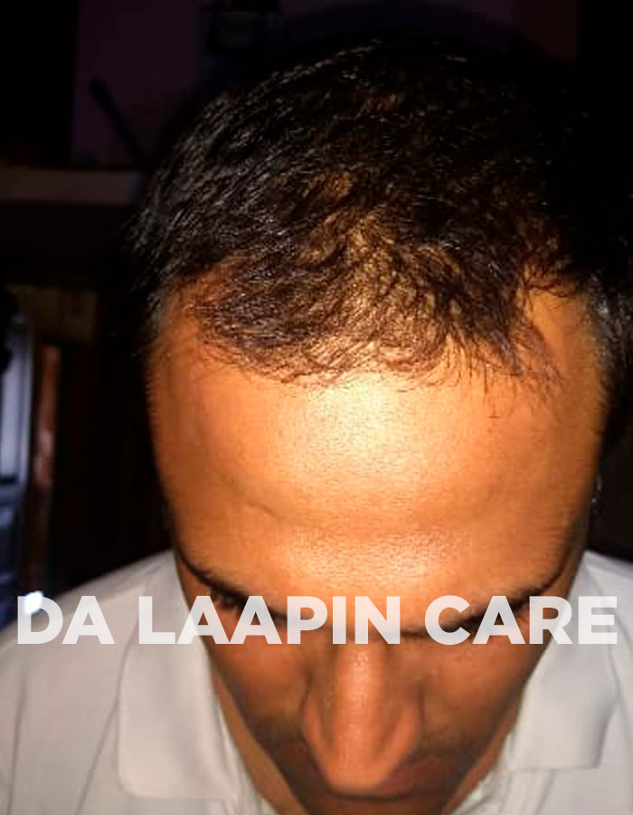 Dalaapincare | Best Hair Restoration Centre