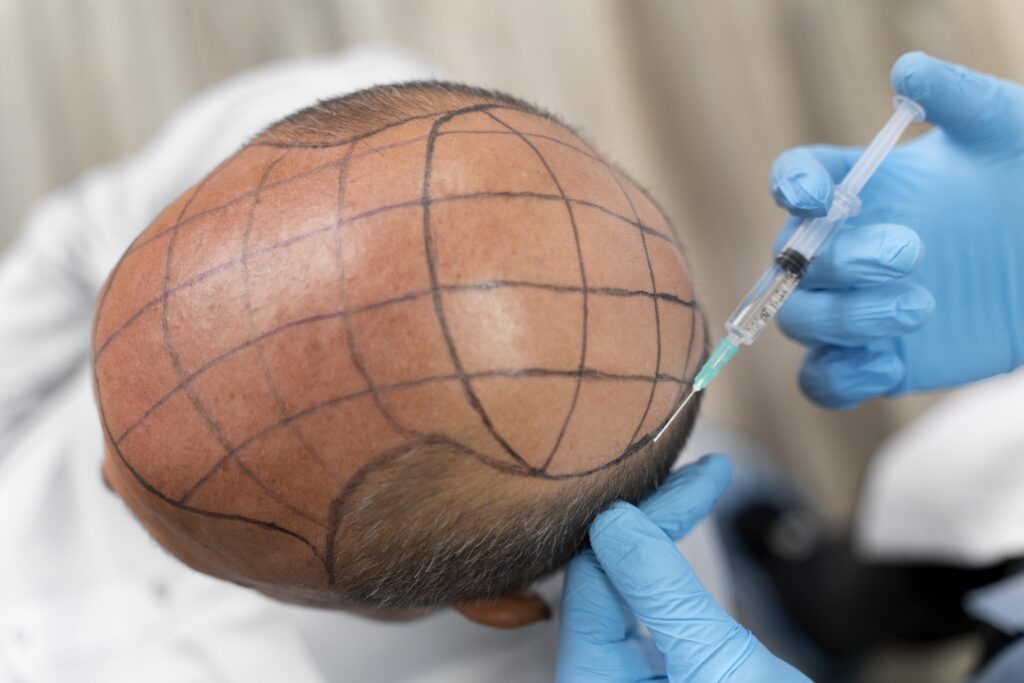 FUE Hair Transplant in Odisha