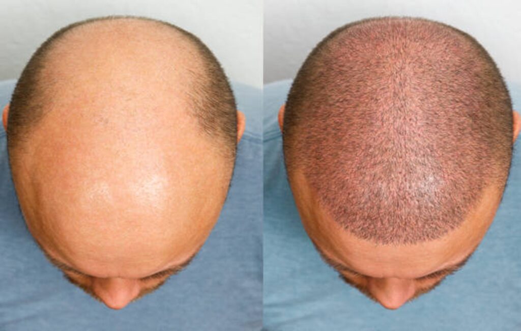 hair transplant in Odisha