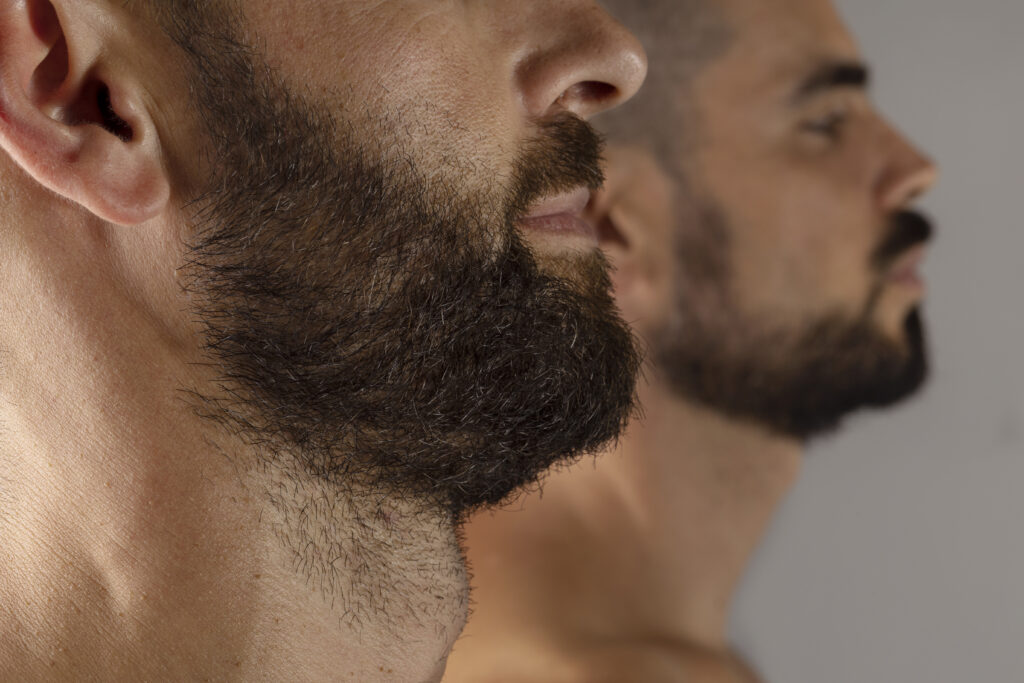 hair transplant for beard