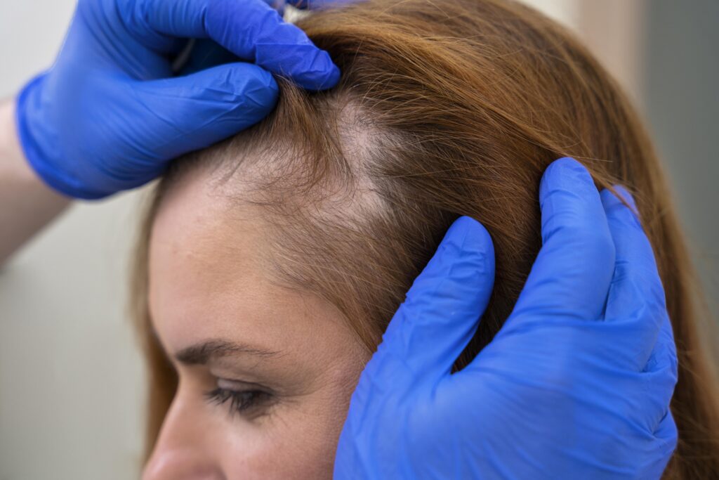 Alopecia Areata Treatment