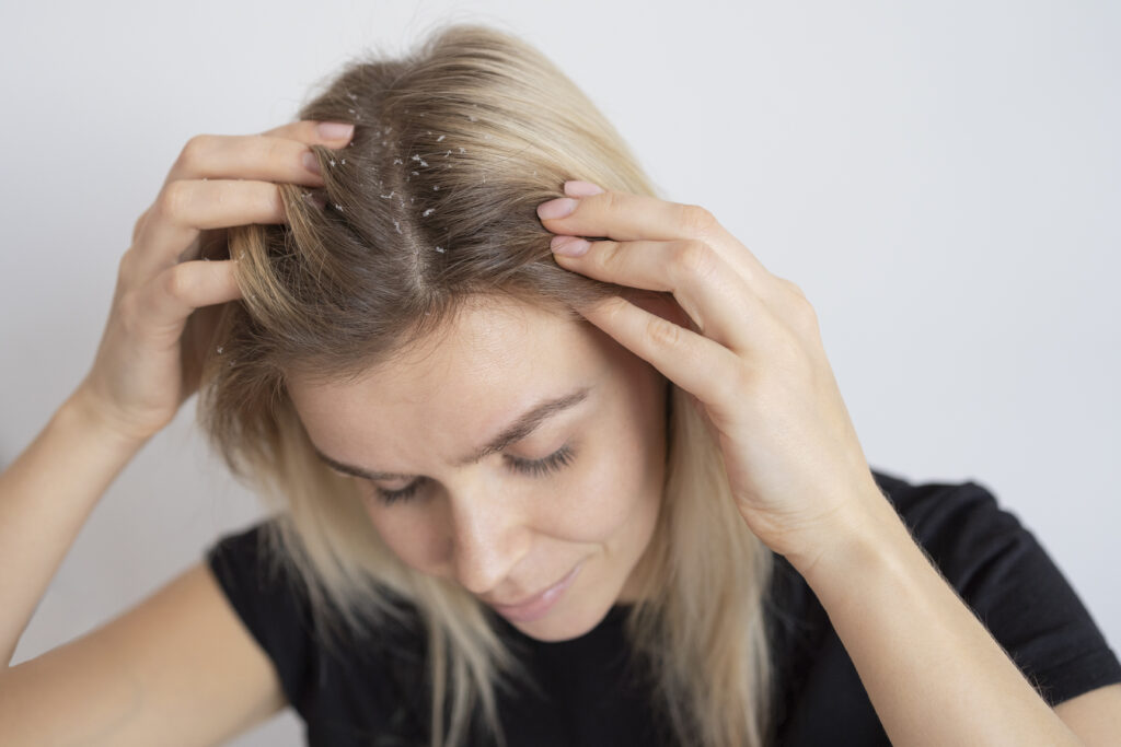 Dandruff and hair loss